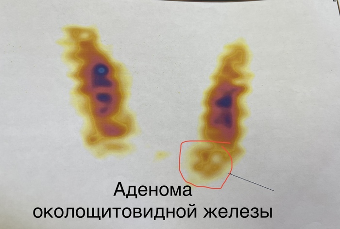 Сцинтиграфия (ОФЭКТ КТ) околощитовидных желез с аденомой